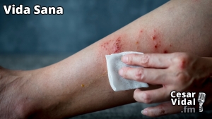 Vida Sana: Psoriasis: Tratamiento natural (2) - 03/05/23